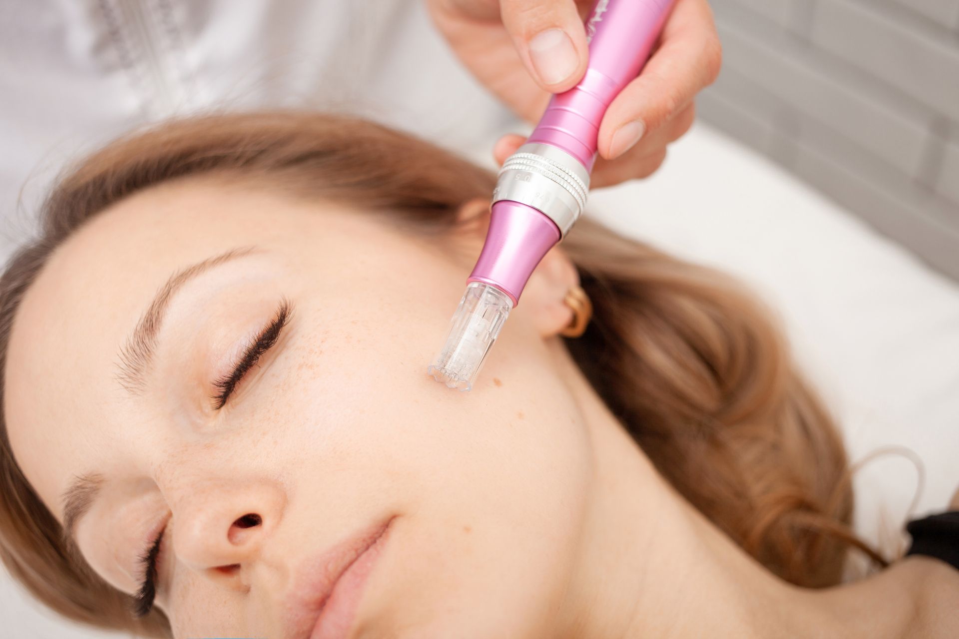 Micro-Needling